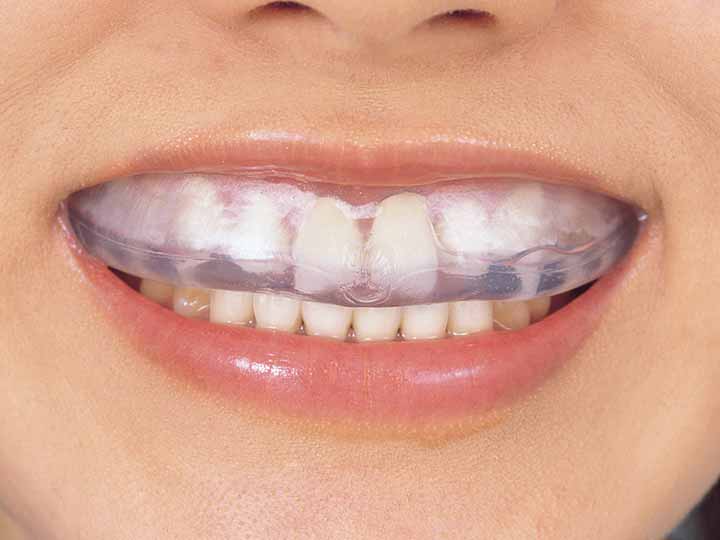 予約 噛み合わせマウスピース_3