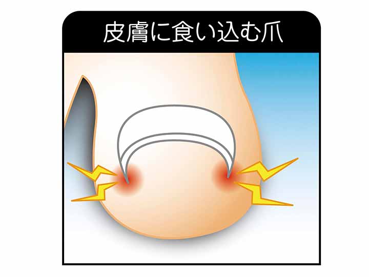 予約　簡単貼るだけ　Ｄｒ巻き爪テープ60枚_5